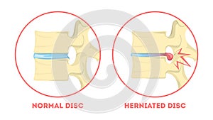 Disc degeneration. Human anatomy. Spine problem. Healthy