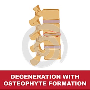 Disc degeneration with osteophyte formation