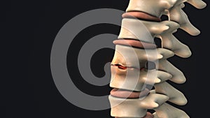 Disc degeneration with osteophyte formation in the human spine