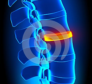 Disc Degeneration - Spine problem