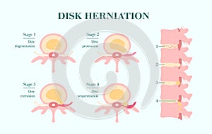 Disc herhetation, four stages and side view of spinal column