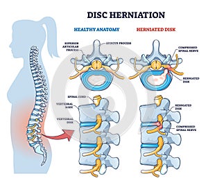 Disc herniation or spine nerve compression vs healthy anatomy outline diagram