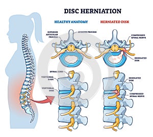 Disc herniation or spine nerve compression vs healthy anatomy outline diagram photo