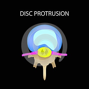 Disc protrusion. Top view. Spine. Infographics. Vector illustration on a black background