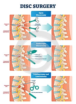 Disc surgery vector illustration. Diagram with back nerves and bones pain.