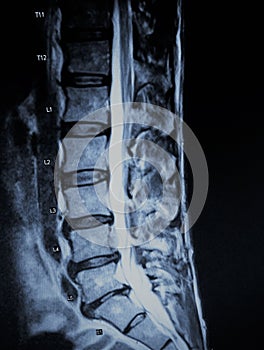 Discogenic pathology extrusion nerve root mri exam