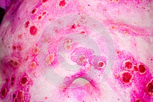 Discoid rash of system lupus eruthematosus photo
