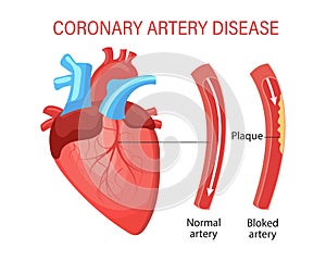 Disease of the coronary artery of the heart. Human anatomy, medical concept. Infographics, banner