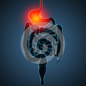 Disease illustration of human stomach