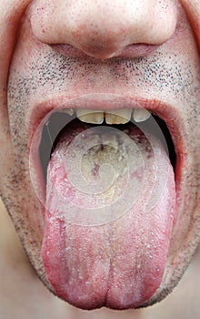 Disease tongue