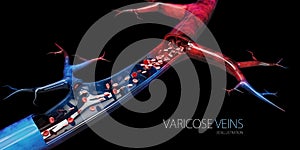 Disease varicose veins, 3d illustration isolated black