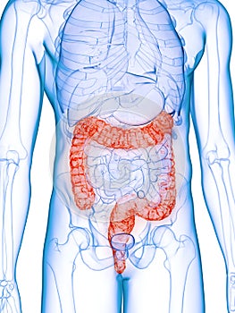 A diseased colon