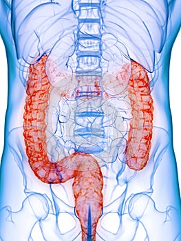 A diseased colon