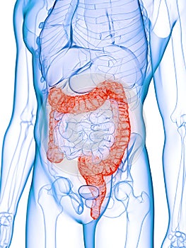A diseased colon