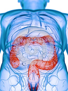 A diseased colon