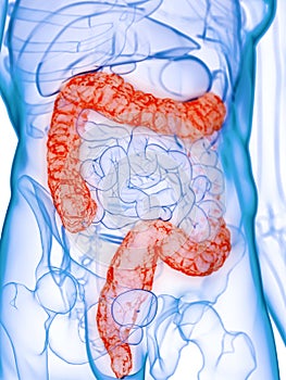 A diseased colon