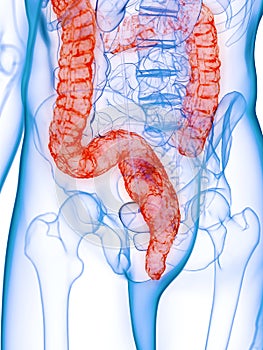 A diseased colon