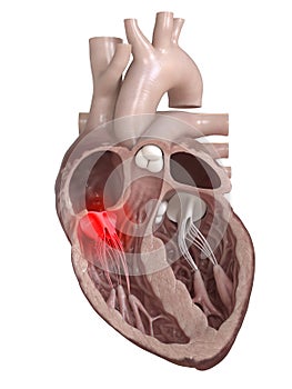 A diseased heart valve