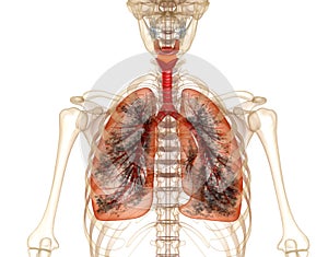 Diseased lungs, Medical accurate 3D illustration