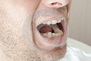 Diseased teeth of the patient