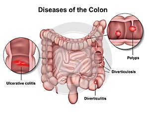 Diseases of the colon 3d medical  illustration on white background