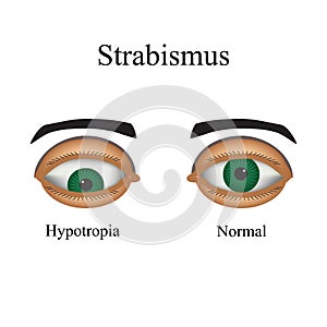 Diseases of the eye - strabismus. A variation of strabismus - Hypotropia