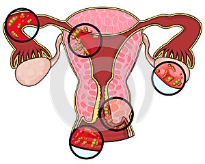 Diseases of female reproductive system