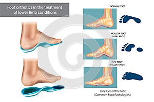 Diseases of the foot. Foot orthotics in the treatment of lower limb conditions