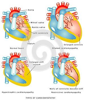 Enfermedades de corazón músculo 