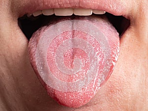 diseases of the oral cavity, tongue infections cancer photo