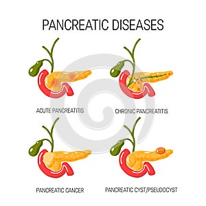 Diseases of the pancreas concept. Vector illustration