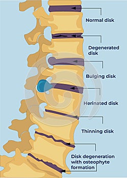 Diseases of the spine. Degenerative changes in the vertebrae