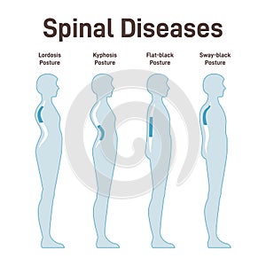 Diseases of the spine. Lordosis, kyphosis, flat-back and sway-back