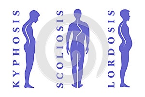 Diseases of the spine. Scoliosis, lordosis, kyphosis. Body posture defect. Human silhouettes on white. Vector illustratio