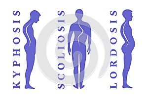 Diseases of the spine. Scoliosis, lordosis, kyphosis. Body posture defect. Human silhouettes on white. Vector illustratio photo