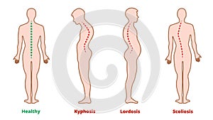 Diseases of the spine. Scoliosis, lordosis, kyphosis. Body posture defects. Back curvature. Spinal deformity types