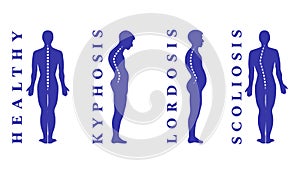 Diseases of the spine. Scoliosis, lordosis, kyphosis. Body posture defects. Back curvature. Spinal deformity types