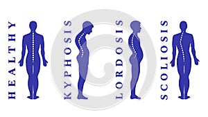 Malattie da colonna vertebrale. scoliosi,,. corpo possesso. curvatura. spinale tipi 