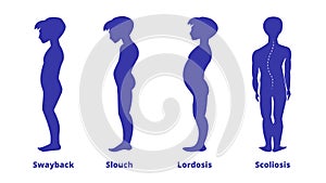 Diseases of the spine. Scoliosis, lordosis, swayback, slouch. Body posture defects. Spinal deformity types. Medical photo