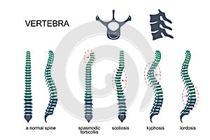 Malattie da colonna vertebrale 