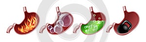 Diseases of stomach. Medical vector illustration set.