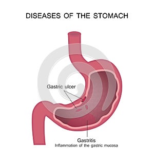 Diseases of the Stomach. Peptic Ulcer and Gastritis. photo