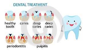 Diseases of teeth. caries, pulpitis, periodontitis. Vector illustration