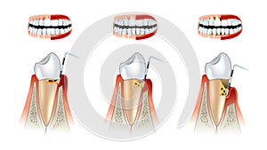 Diseases of teeth dental scheme. Alveolysis