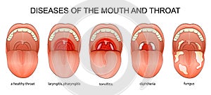 DISEASES OF THE THROAT