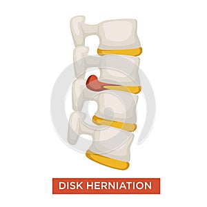 Disk herniation spine disease bone inflammation vector illustration