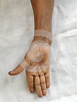 Dislocated hand after wrist fracture