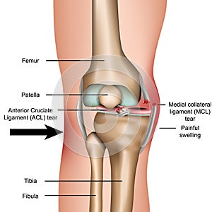 Dislocated knee, medial collateral ligament tear medical vector illustration isolated on white background