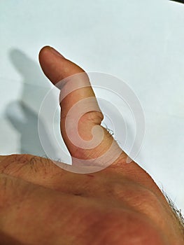 Dislocated little finger joint before treatment and healing