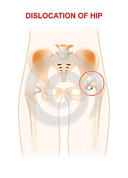 Dislocation of hip photo